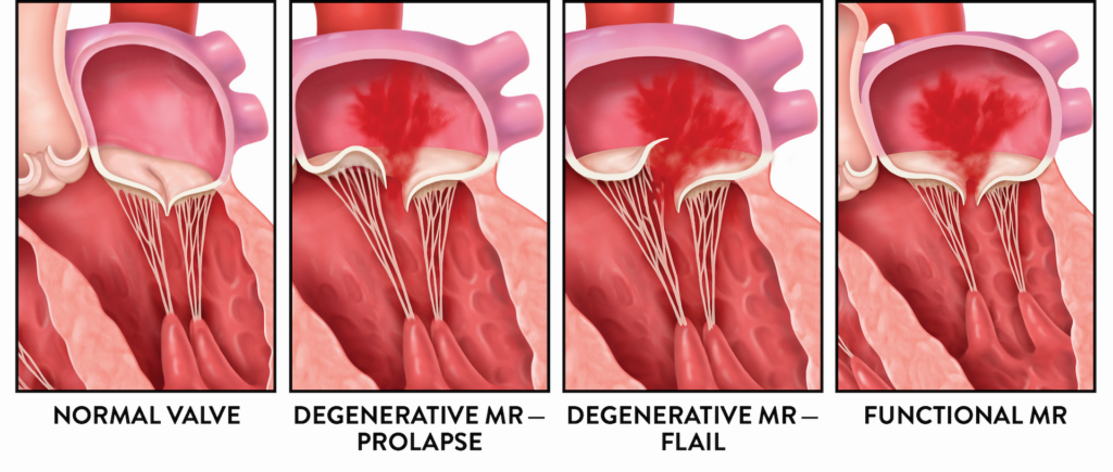 mitral-regurgitation-types-illustration