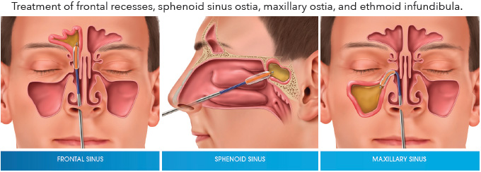 balloon-sinuplasty-illustration