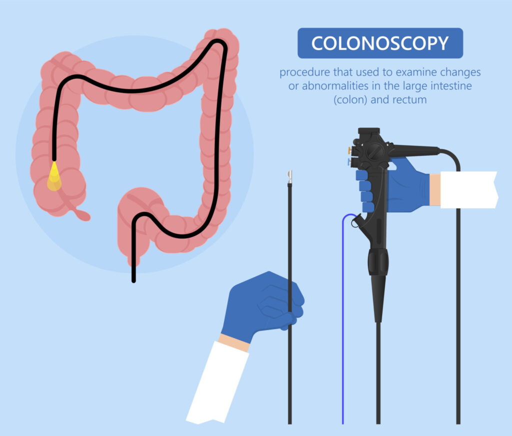 How Long Colonoscopy Last What Is The Colonoscopy Procedure XHJRUO How Long Colonoscopy Last What Is The Colonoscopy Procedure XHJRUO
