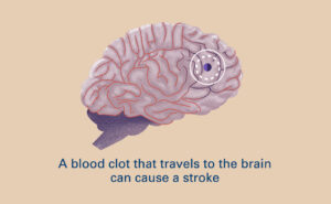 blood-clot-brain-illustration