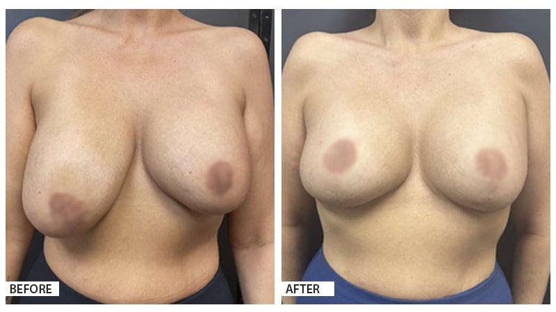 Mastopexy