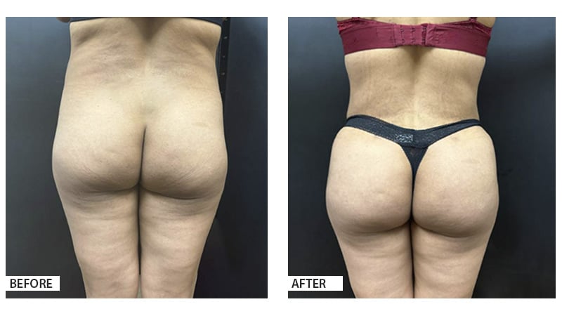 Brazilian Butt Lift