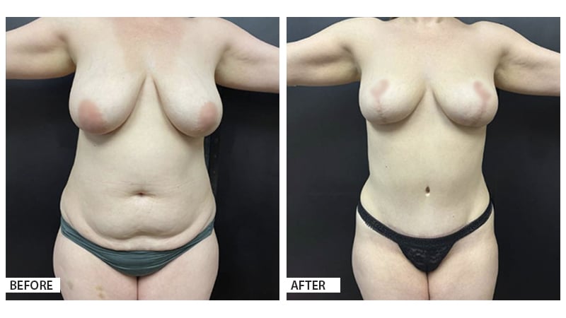 Mommy Makeover