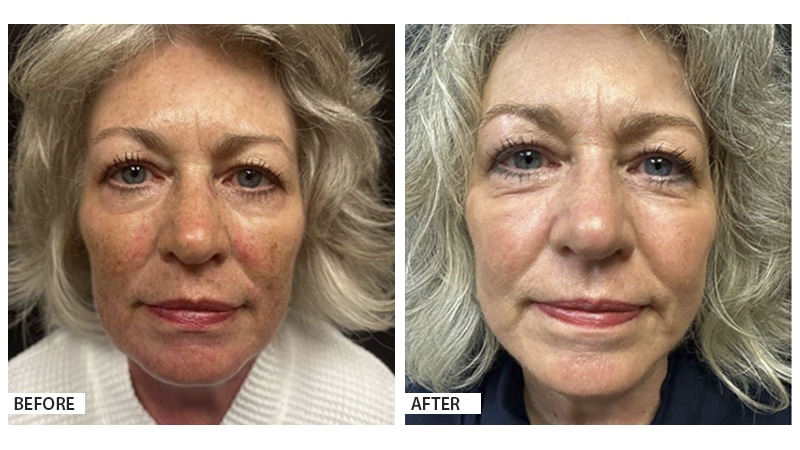 Face and Neck Lift