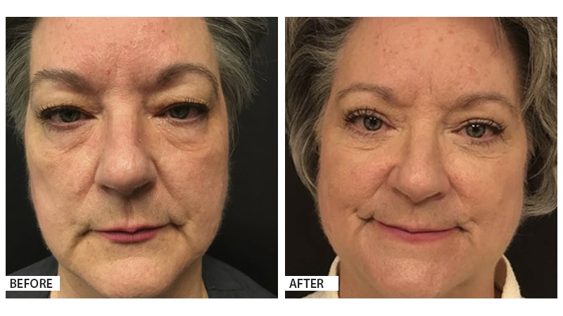 Blepharoplasty