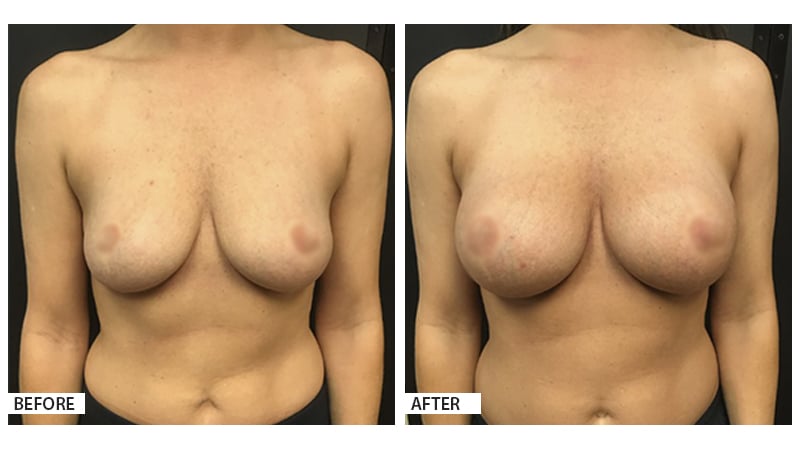 Breast Augmentation