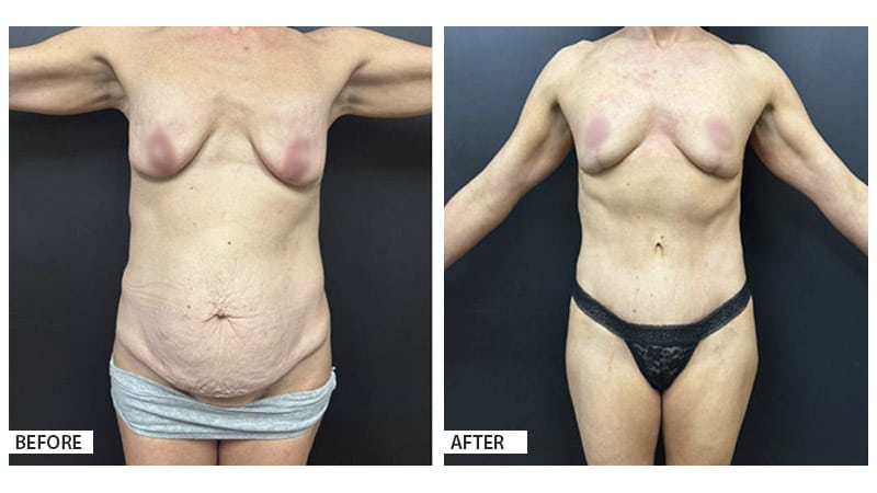 Mastopexy/Tummy Tuck