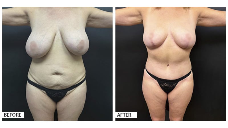 This 54-year-old patient underwent a Mommy Makeover surgery to address changes in her body following two pregnancies.