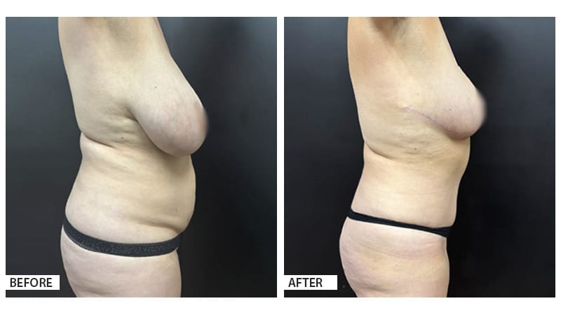 This 54-year-old patient underwent a Mommy Makeover surgery to address changes in her body following two pregnancies.