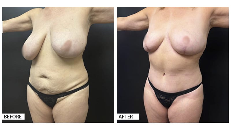 This 54-year-old patient underwent a Mommy Makeover surgery to address changes in her body following two pregnancies.