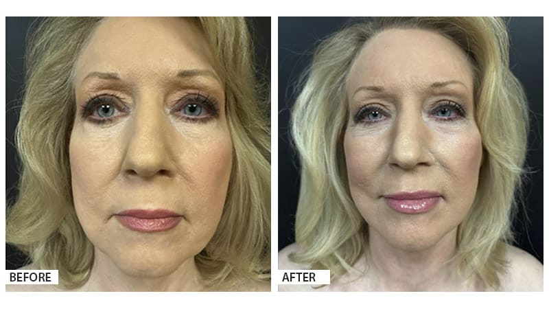 Face and neck lift, Hattiesburg Clinic Plastic Surgery