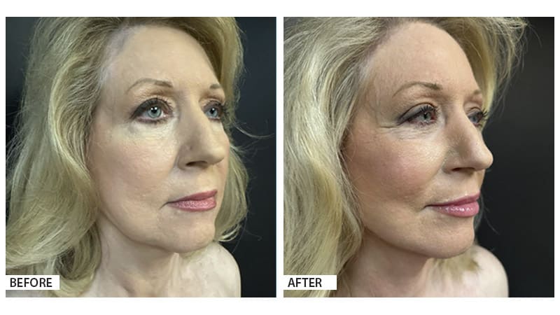 Face and neck lift, Hattiesburg Clinic Plastic Surgery