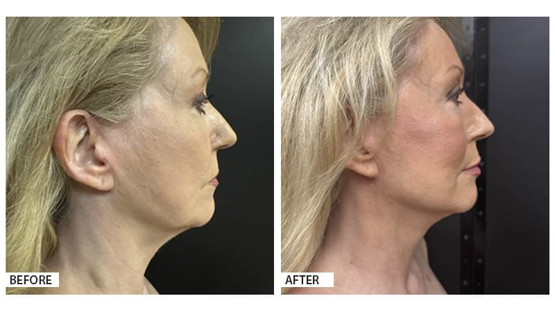 Face and neck lift, Hattiesburg Clinic Plastic Surgery