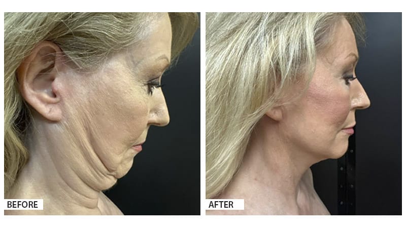 Face and neck lift, Hattiesburg Clinic Plastic Surgery